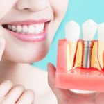 Cost of Dental Implants