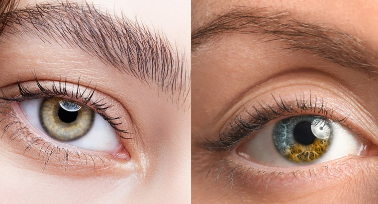 hazel eyes vs central heterochromia